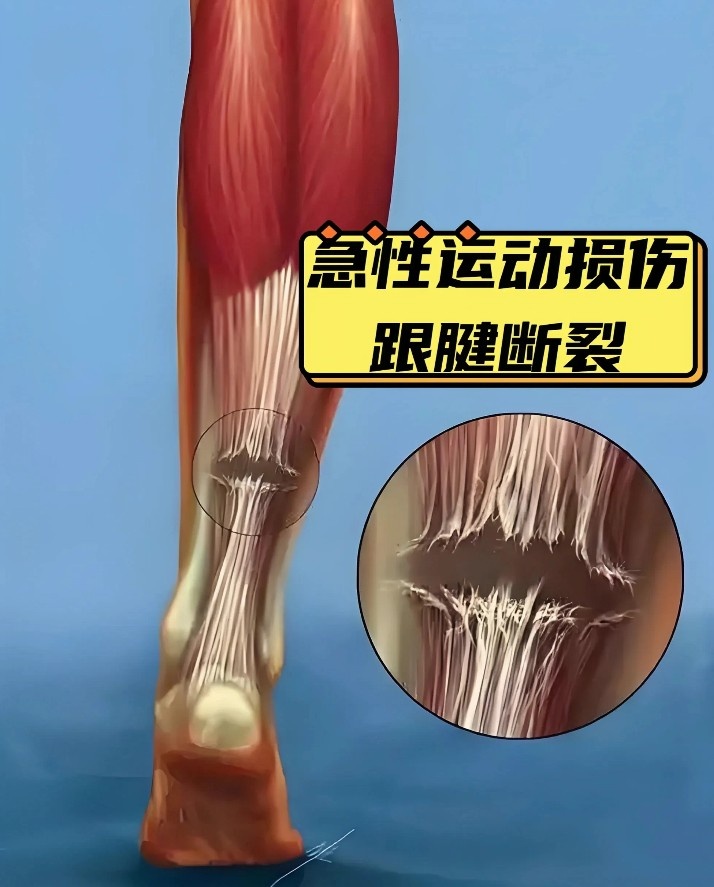 10个月康复已算快！跟腱撕裂为什么是竞技体育的“阿喀琉斯之踵”